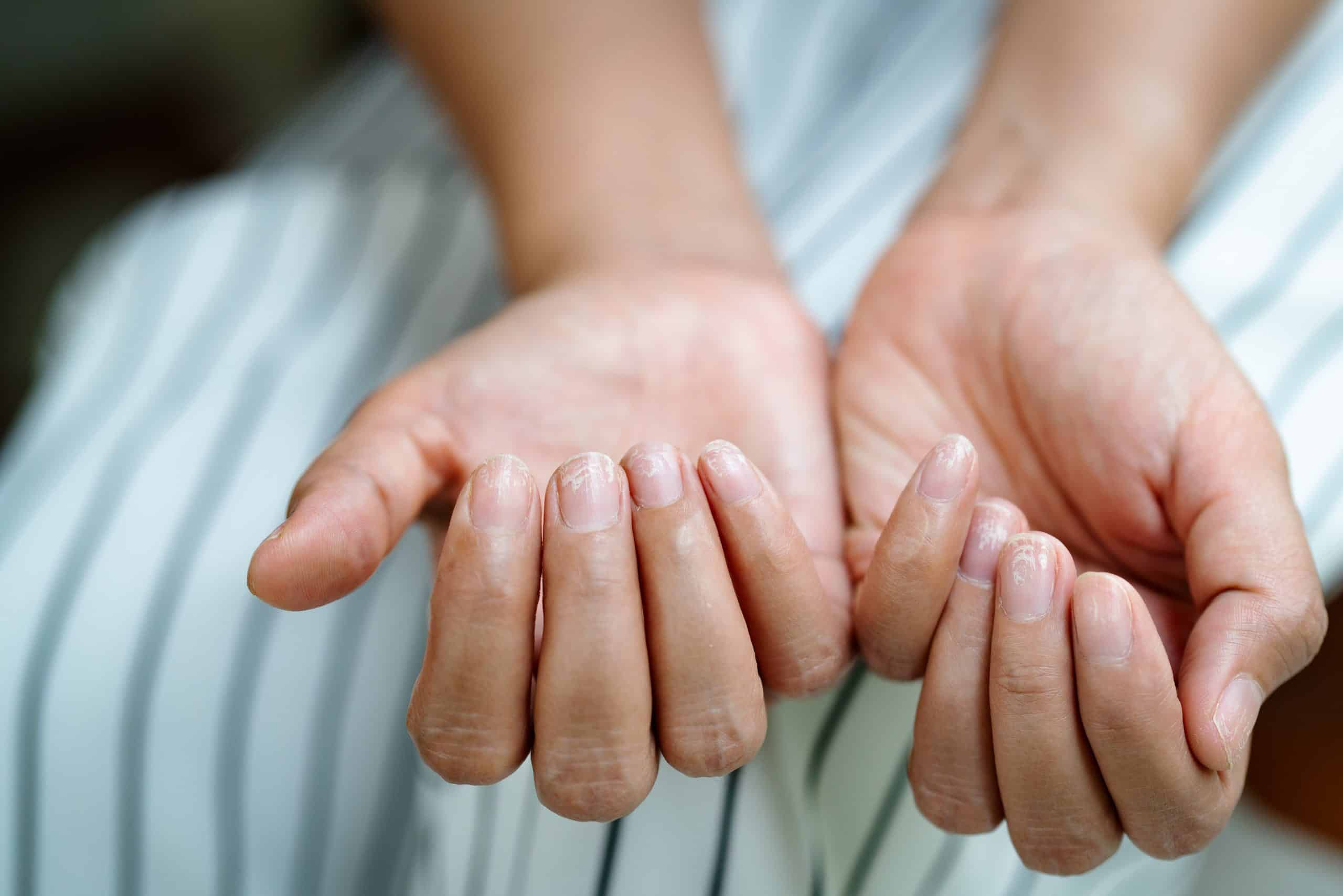 Pitted Nails on patient's Hands - Psoriasis Concerns