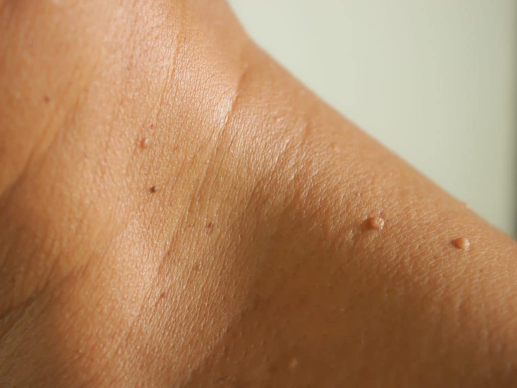 Close up of Skin Tags on the shoulder of a Patient - Skin Tag Concerns