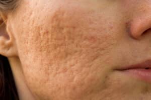 acne scars