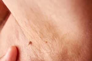 Large papilloma under the armpit of a man. Skin disease. Skin care.