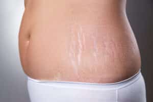 Patient with Stretch Marks on the side of the Abdomen