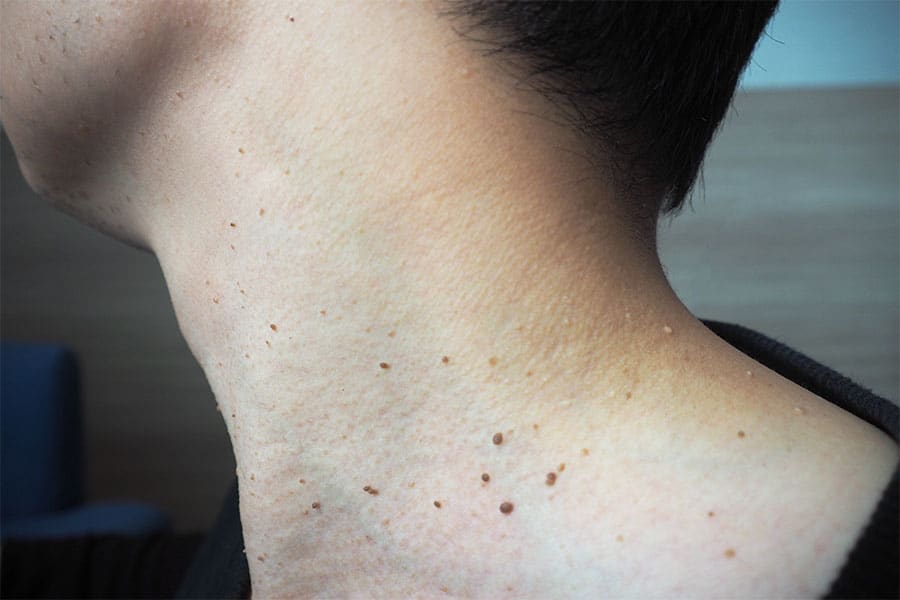 Close-up of several small skin tags on the side of a person's neck