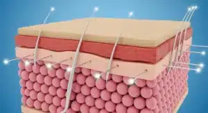 A facial thread lift.