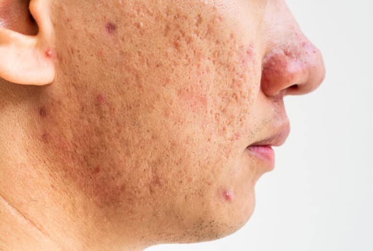 Acne scars for treatment in Singapore.