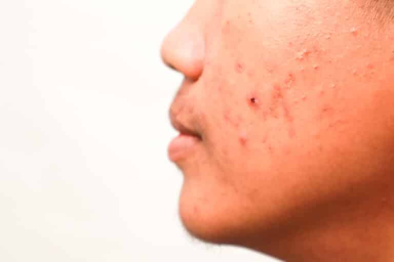 Side view of an asian man's face showing texture of acne pimples and red inflamed skin indicating