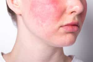 Rosacea is a skin condition requiring specialist treatment in Singapore