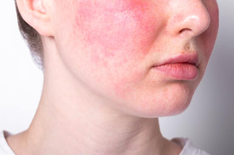 Rosacea is a skin condition requiring specialist treatment in Singapore