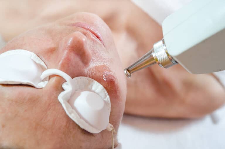Woman undergoing laser skin treatment