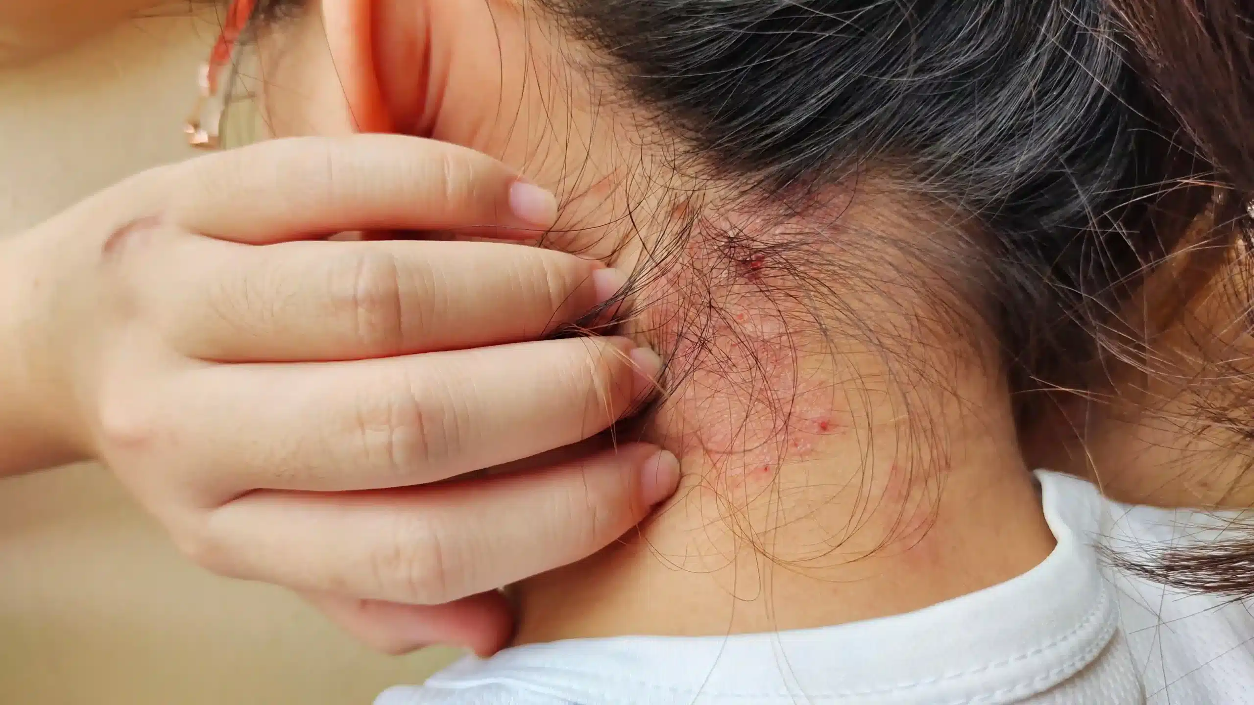 Fungal acne.