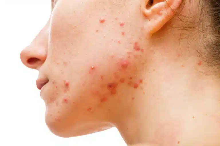 Cystic acne on the face of a woman