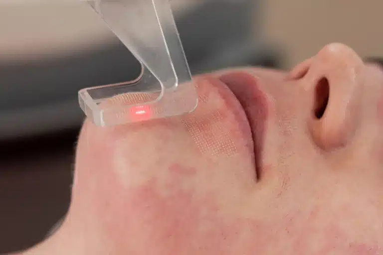 Patient getting a fractional laser in Singapore