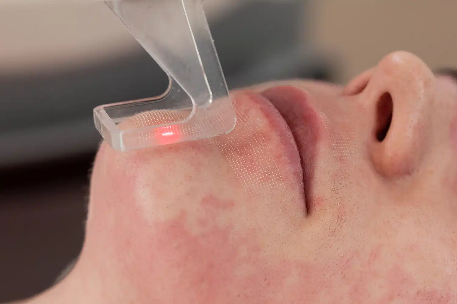 Patient getting a fractional laser in Singapore