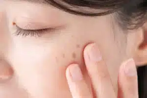 Woman with facial pigmentations