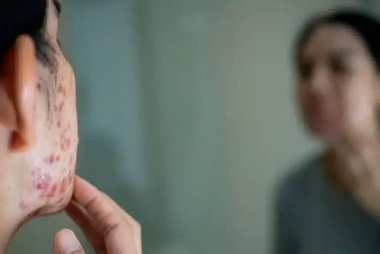 Woman looking at her jaw with acne in the mirror