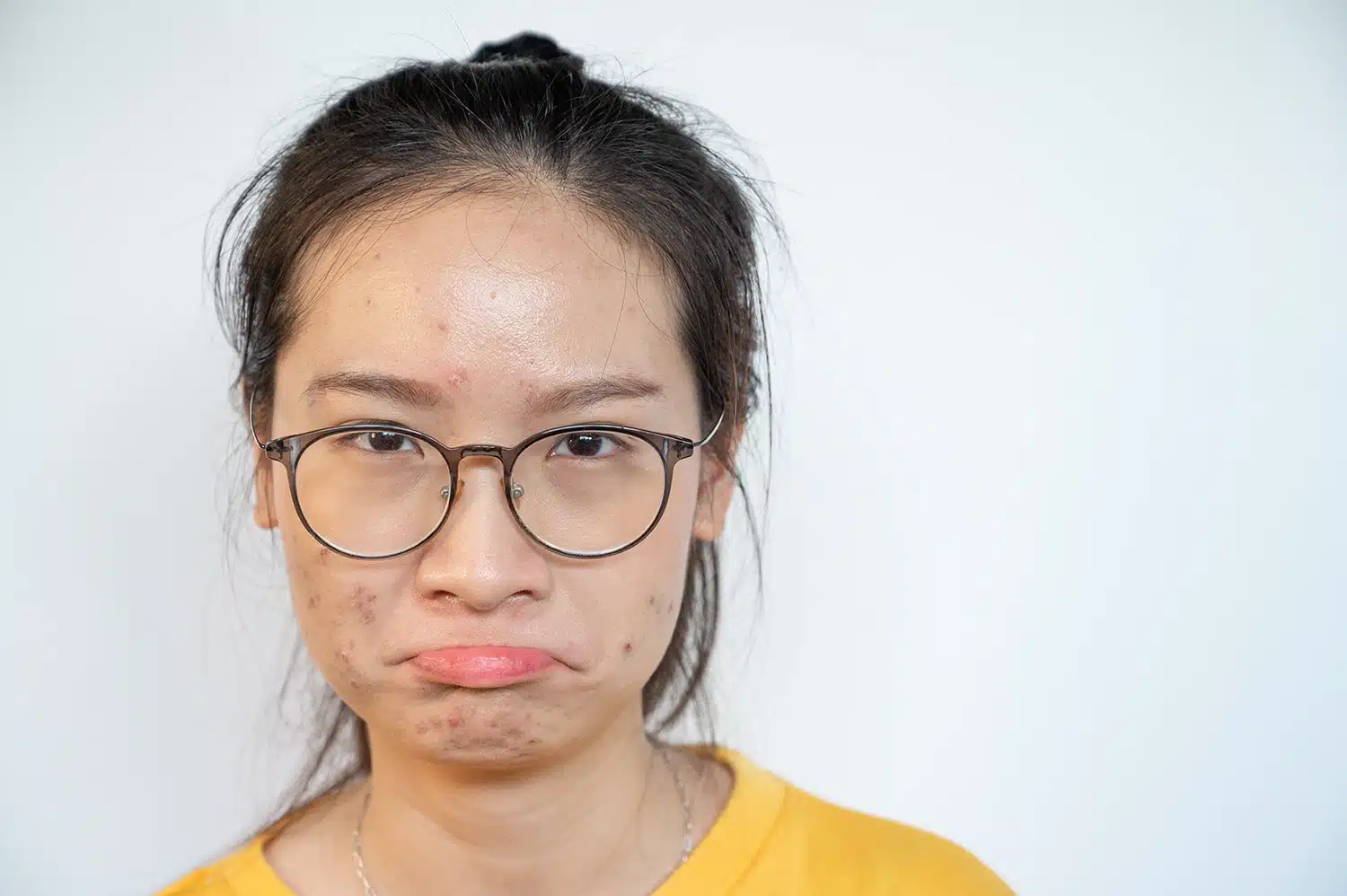 Image of a woman with Acne