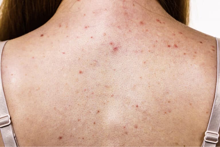 Woman with Back acne